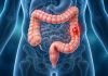colorectal cancer — Why Are Young Adults Facing a Surge in Early-Onset Cases? colorectal cancer